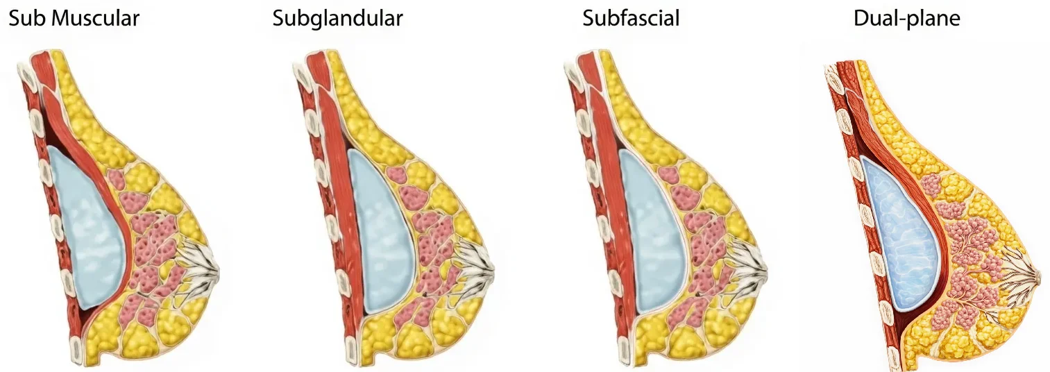 Diferentes planos de colocação do implante mamário.