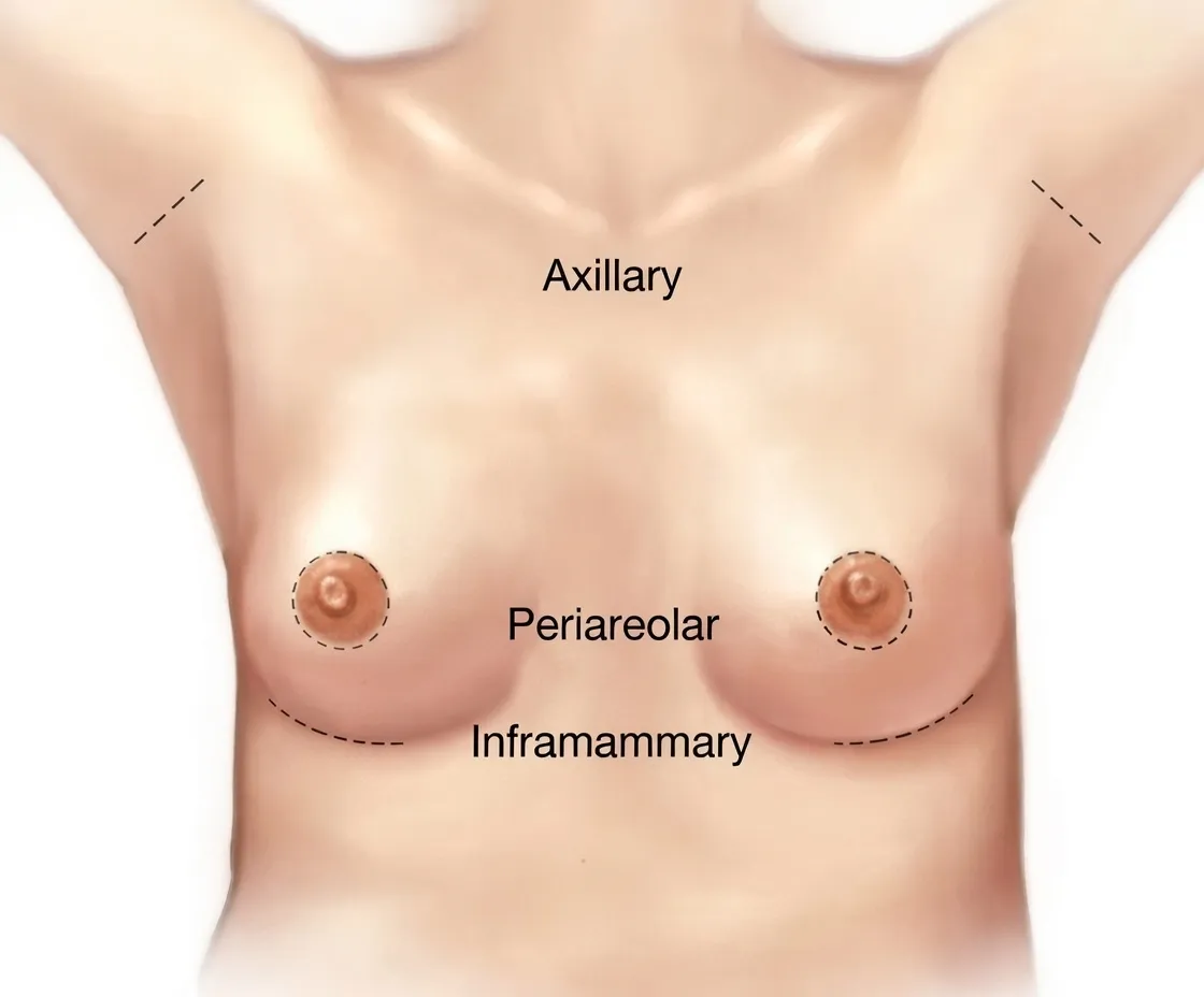 Ilustração das principais vias de acesso para inclusão de prótese de mama.