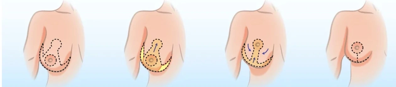 Ilustração das técnicas (cicatrizes) mais comuns em cirurgias de mama: Periareolar, Pirulito (Vertical) e T Invertido.